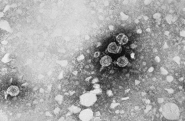 BREAKING: Outbreak Of Hepatitis In Ukraine - Vinnytsia Locked Down